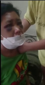 ART Bernama Rohima Kondisinya Memprihatinkan, Wajahnya Penuh Lebam